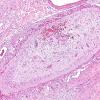 4B3 Encephalocele (Case 4) H&E 3