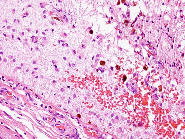 4B4 Encephalocele (Case 4) H&E 4