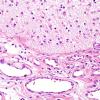 4B5 Encephalocele (Case 4) H&E 5