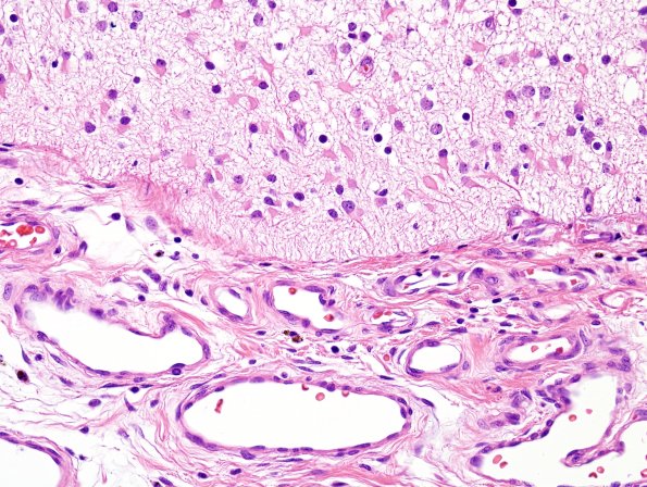 4B5 Encephalocele (Case 4) H&E 5