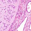 4B6 Encephalocele (Case 4) H&E 6