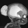 5A1 Encephalocele (Case 5) T2 HASTE 1 - Copy