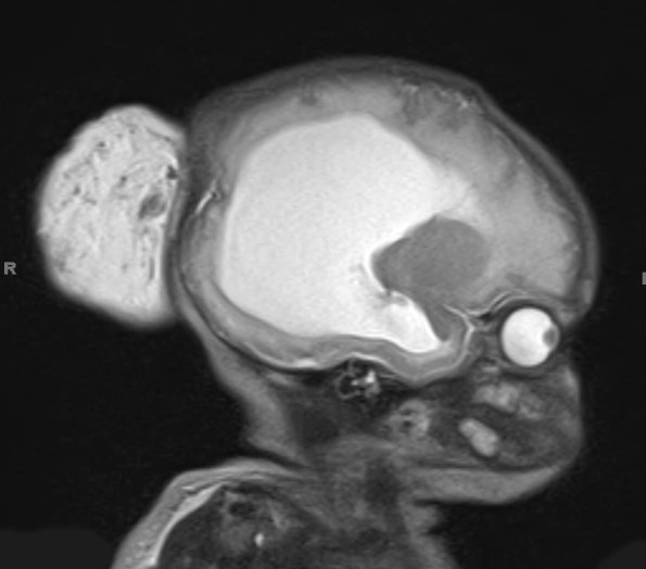 5A1-Encephalocele-Case-5-T2-HASTE-1-Copy