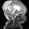 5A2 Encephalocele (Case 5) T2 HASTE 2 - Copy