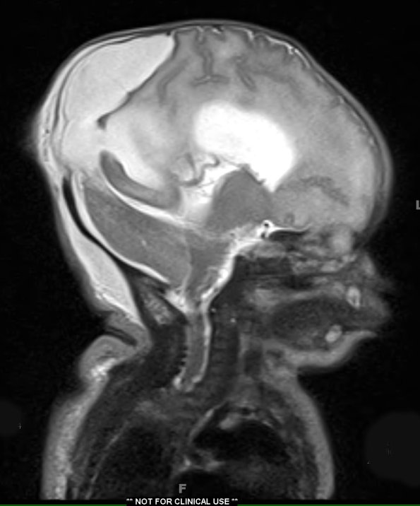 5A2 Encephalocele (Case 5) T2 HASTE 2 - Copy