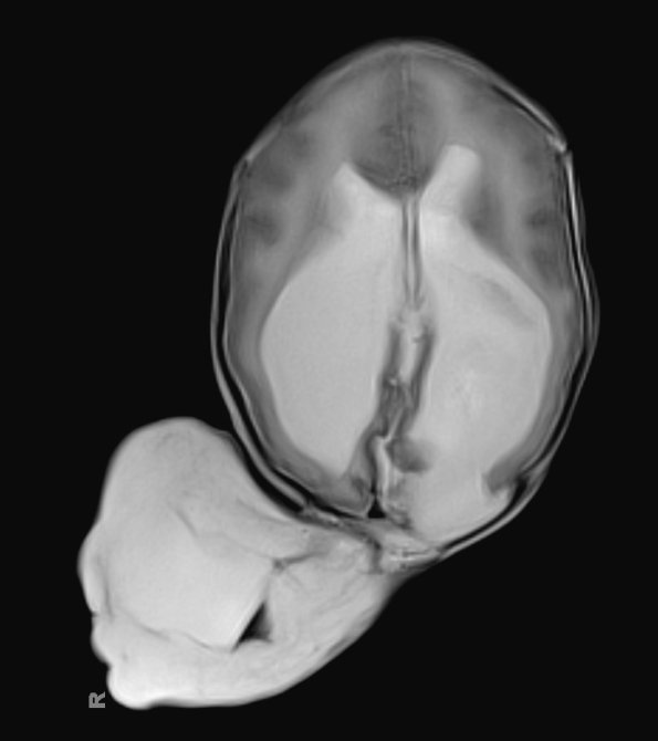 5A3-Encephalocele-Case-5-T2-BLADE-2-Copy