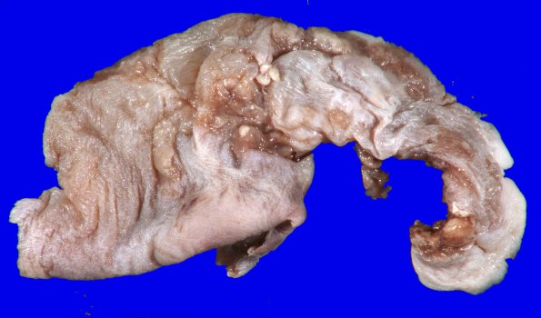 5B1 Encephalocele (Case 5) Surgical specimen_1