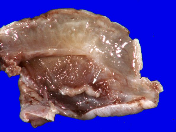 5B3 Encephalocele (Case 5) Surgical specimen_3 copy