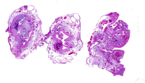 5C1 Encephalocoele (Case 5) H&E whole mount