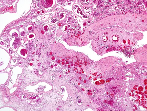 5C2 Encephalocoele (Case 5) H&E 2