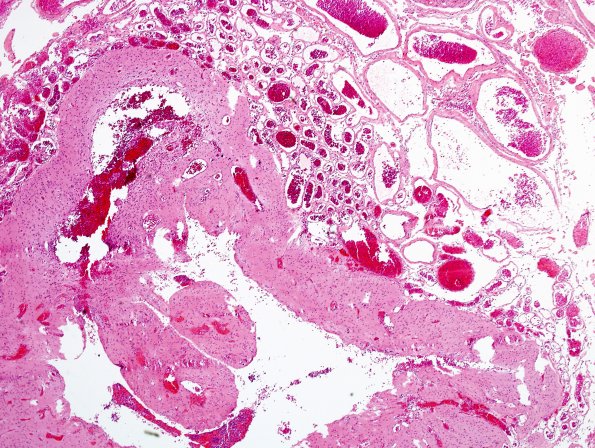 5C3 Encephalocoele (Case 5) H&E 1