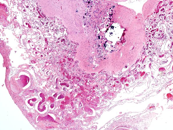 5C4 Encephalocoele (Case 5) H&E 3