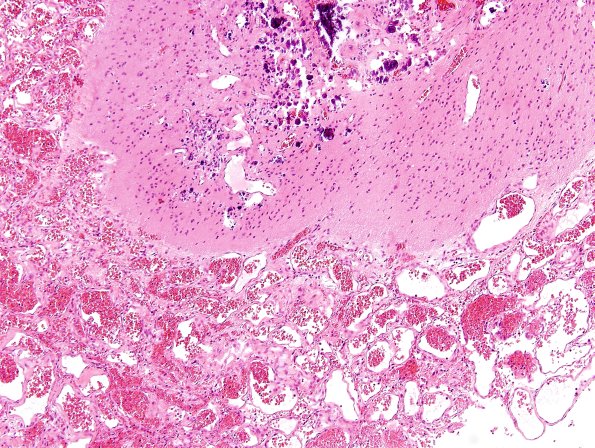 5C5-Encephalocoele-Case-5-H-E-5