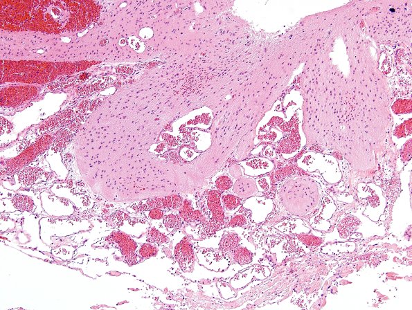 5C6-Encephalocoele-Case-5-H-E-6