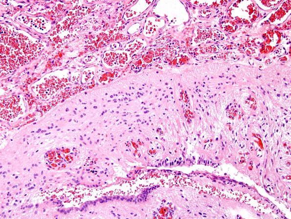 5C7-Encephalocoele-Case-5-H-E-8