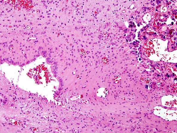 5C8-Encephalocoele-Case-5-H-E-11