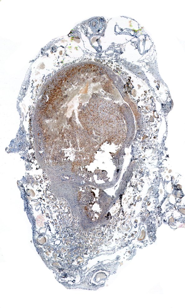 5D1-Encephalocoele-Case-5-NeuN-3