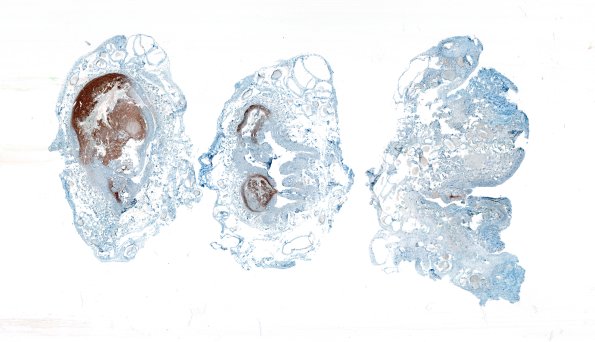 5E1-Encephalocoele-Case-5-NF-whole-mount