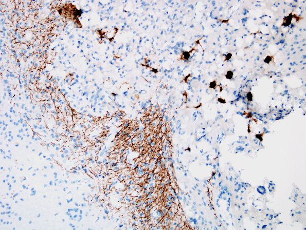 5E2-Encephalocoele-Case-5-NF-5