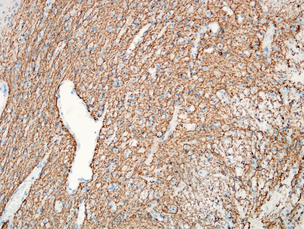 5E3 Encephalocoele (Case 5) NF 4