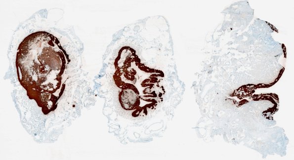 5F1-Encephalocoele-Case-5-GFAP-whole-mount