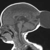 6A1-Encephalocele-Case-6-T1-FLASH-Copy