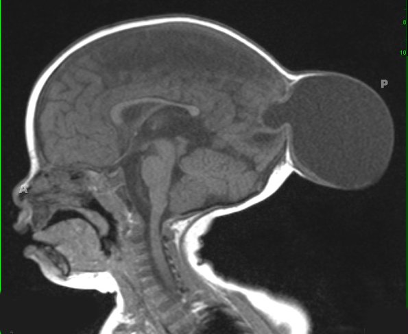 6A1-Encephalocele-Case-6-T1-FLASH-Copy