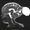 6A2-Encephalocele-Case-6-T2-HASTE-Copy