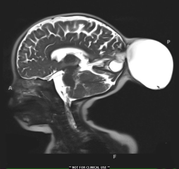 6A2-Encephalocele-Case-6-T2-HASTE-Copy