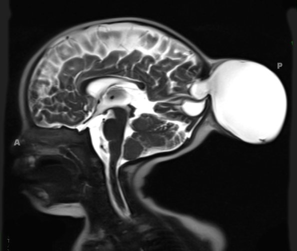 6A3-Encephalocele-Case-6-T2-HASTE-3-Copy