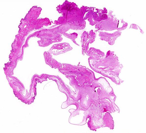 6B1 Encephalocele (Case 6) H&E WM 1