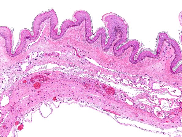 6B2-Encephalocele-Case-6-H-E-1.jpg