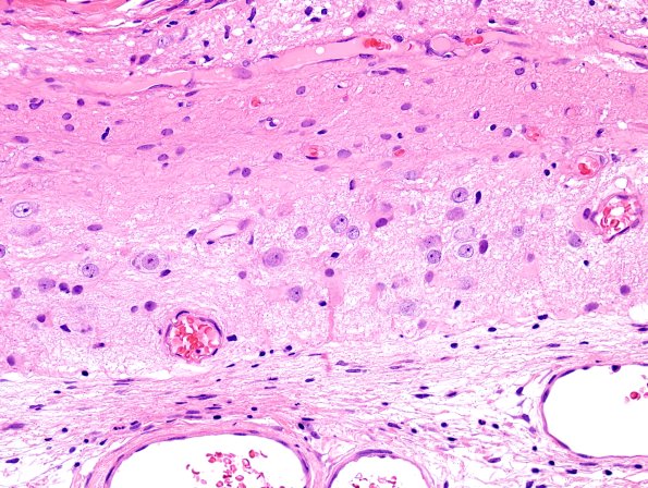 6B3-Encephalocele-Case-6-H-E-2.jpg