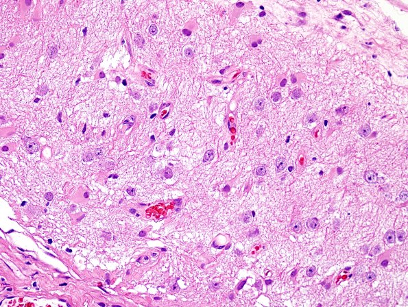 6B4-Encephalocele-Case-6-H-E-15.jpg