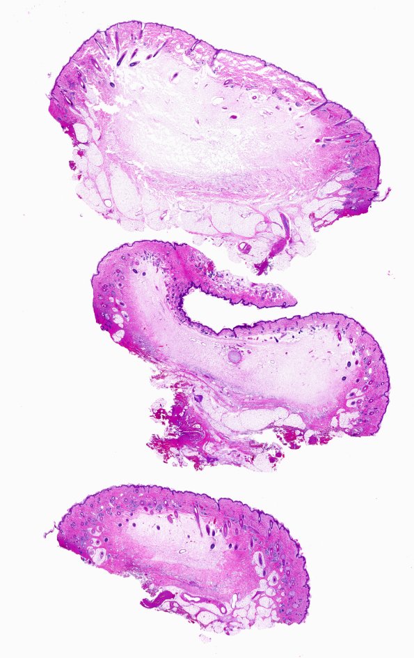 7A1-Encephalocele-Case-7-H-E-whole-mount-1A