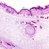 7A2 Encephalocele (Case 7) H&E 1A