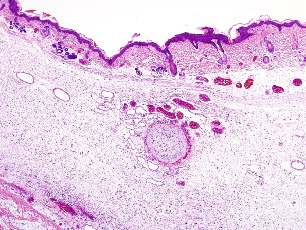 7A2 Encephalocele (Case 7) H&E 1A