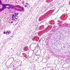 7A3 Encephalocele (Case 7) H&E 2