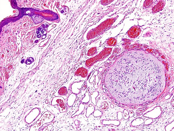 7A3-Encephalocele-Case-7-H-E-2