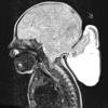 8A Encephalocoele (Case 8) T2 - Copy