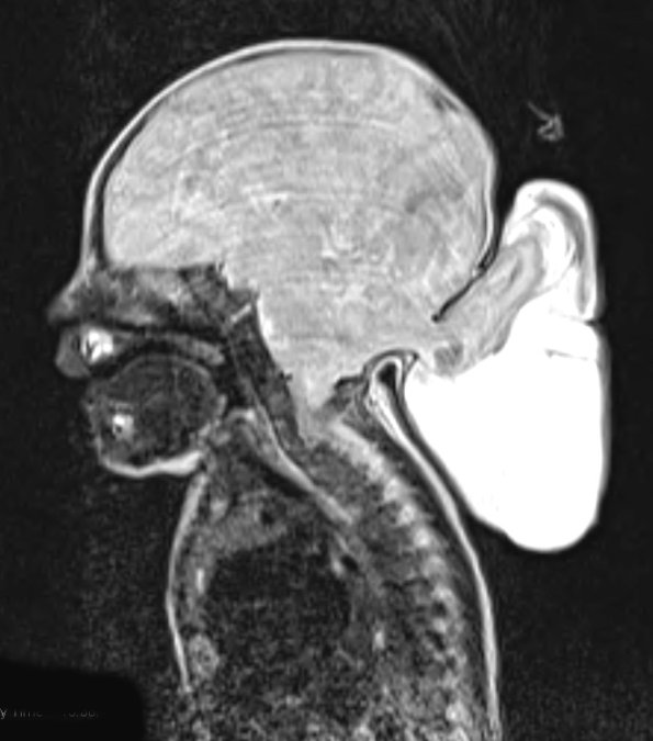 8A Encephalocoele (Case 8) T2 - Copy