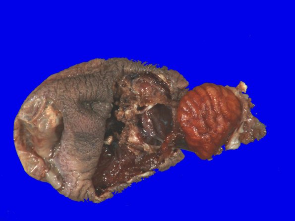 8B Encephalocoele (Case 8)
