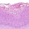 8C2 Encephalocoele (Case 8) H&E 2