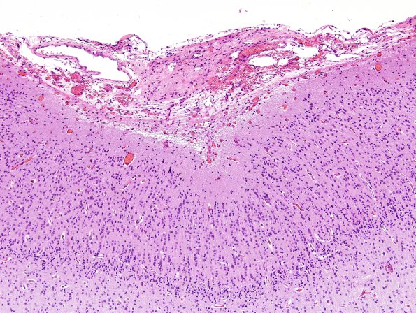 8C2-Encephalocoele-Case-8-H-E-2