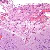 8C3 Encephalocoele (Case 8) H&E 3