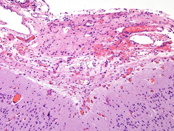 8C3-Encephalocoele-Case-8-H-E-3