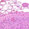 8C4 Encephalocoele (Case 8) H&E 7