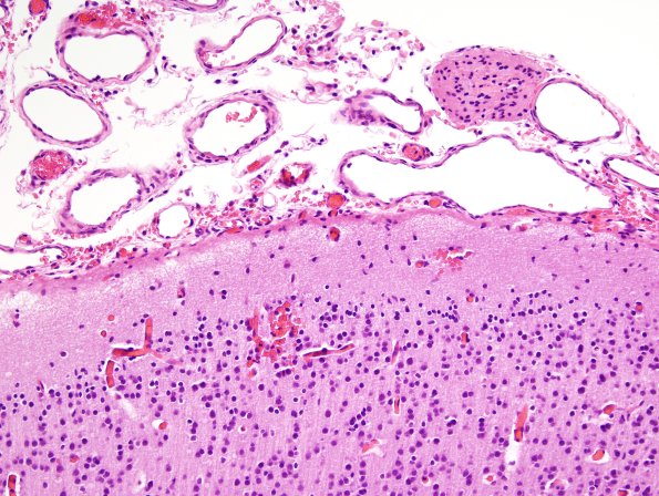 8C4 Encephalocoele (Case 8) H&E 7