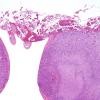 8C5 Encephalocoele (Case 8) H&E 9