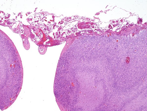 8C5-Encephalocoele-Case-8-H-E-9